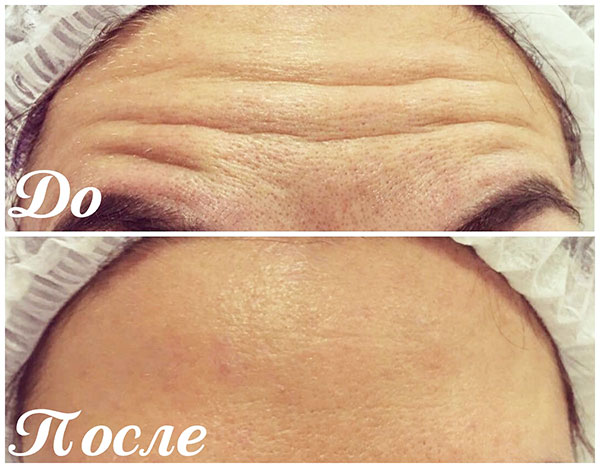 Réparation des rides du front