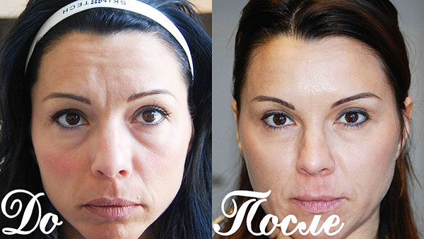Élimination du pli sourcil avec Botox (à préciser avant et après l'intervention)