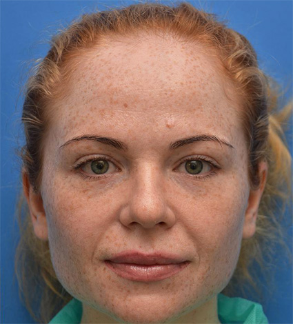 Botox correction du sillon nasogénien