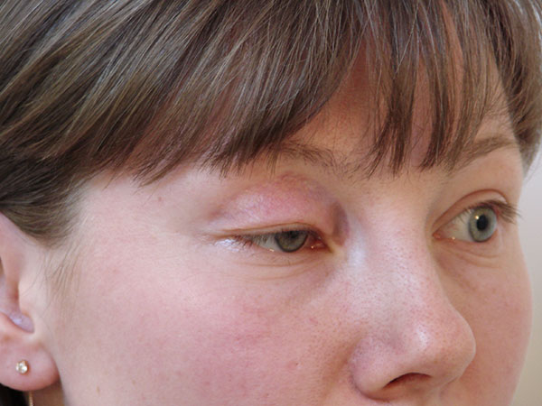 La ptose du siècle est un effet secondaire de la thérapie botulique