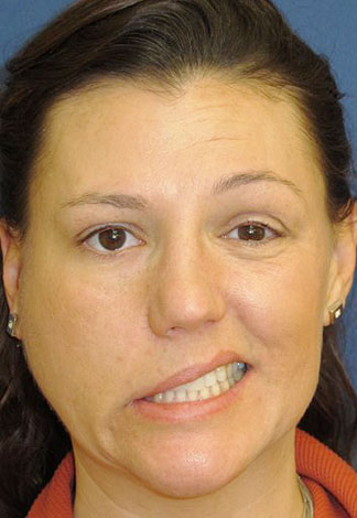 Les relaxants musculaires appliqués sur la peau peuvent immobiliser les muscles non ciblés