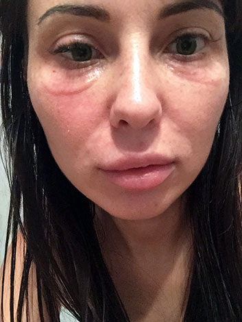 Gonflement et rougeur après le Botox est normal