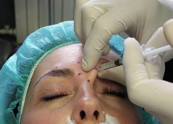 L'introduction du médicament toxine botulique dans la zone des sourcils