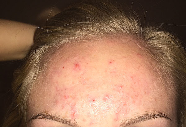 Eruption cutanée après injection de toxine botulique