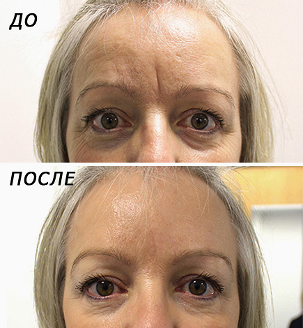 Élimination du botox interbrow (avant, après)