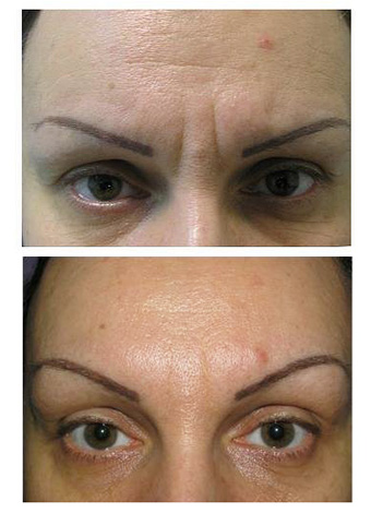Le résultat de l'élimination des sourcils rides Botox
