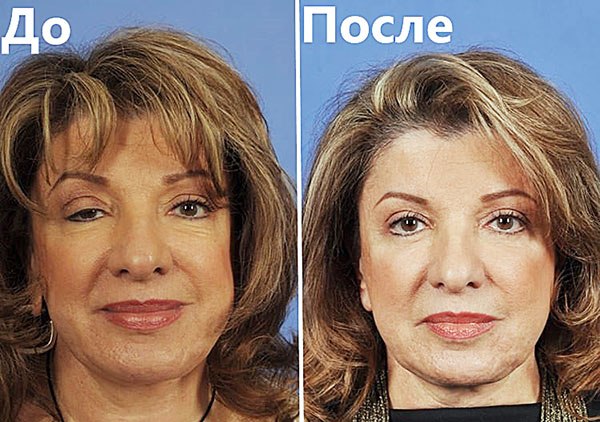 Botpharospasme fix Botox