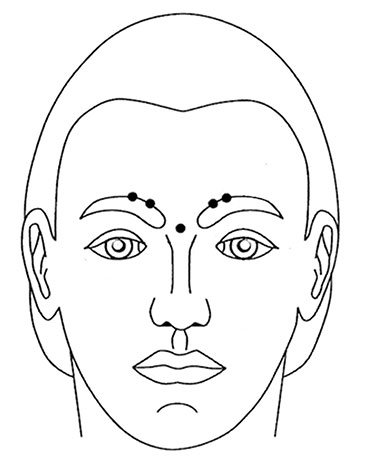 Points d'intersection du Botox
