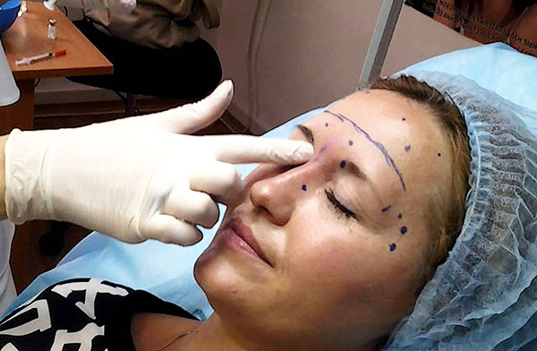 Esthéticienne détermine les lieux d'introduction du médicament toxine botulique