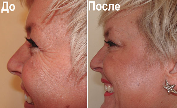 Élimination de la patte d'oie avec la toxine botulique