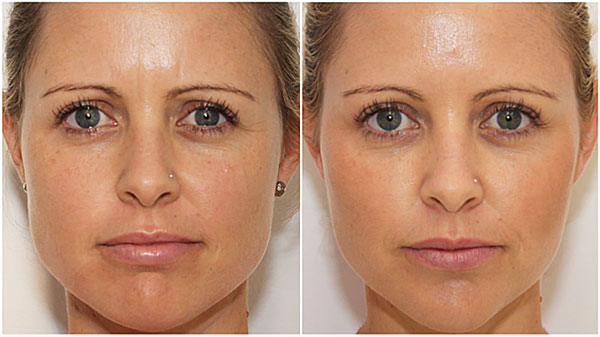 Correction ovale du visage avec des préparations de toxine botulique