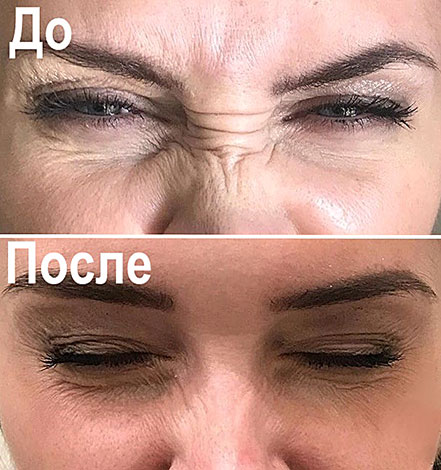 Éliminer les rides du lapin