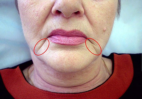 Botox: les rides ne peuvent pas être éliminées