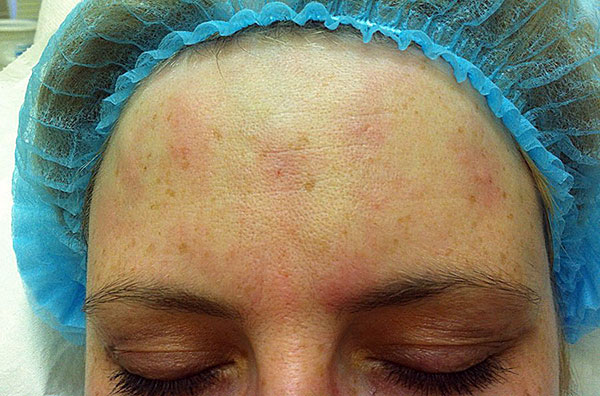 Rougeur après thérapie botulique